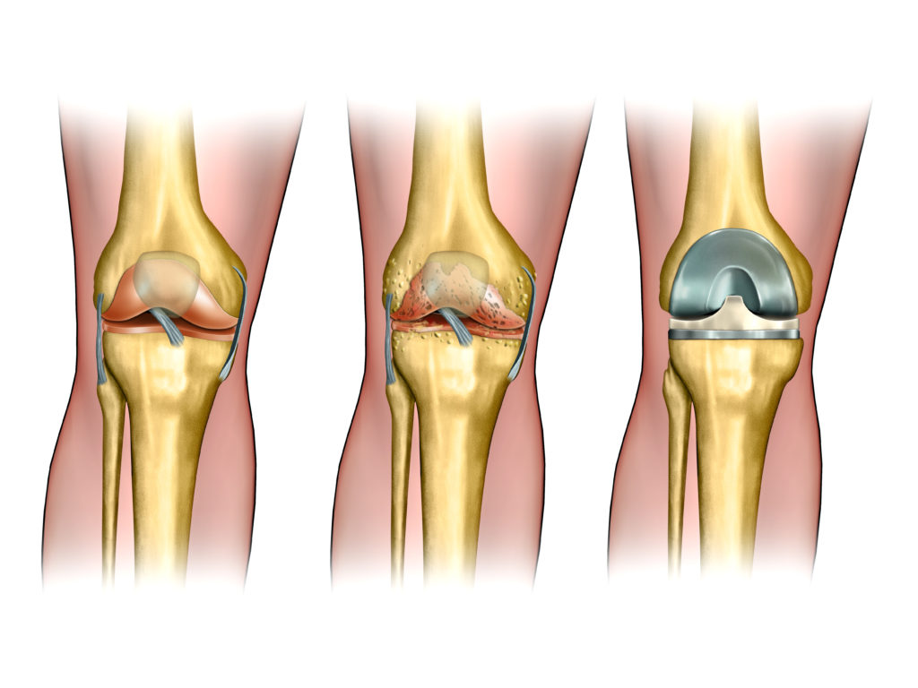 can you cycle with a knee replacement